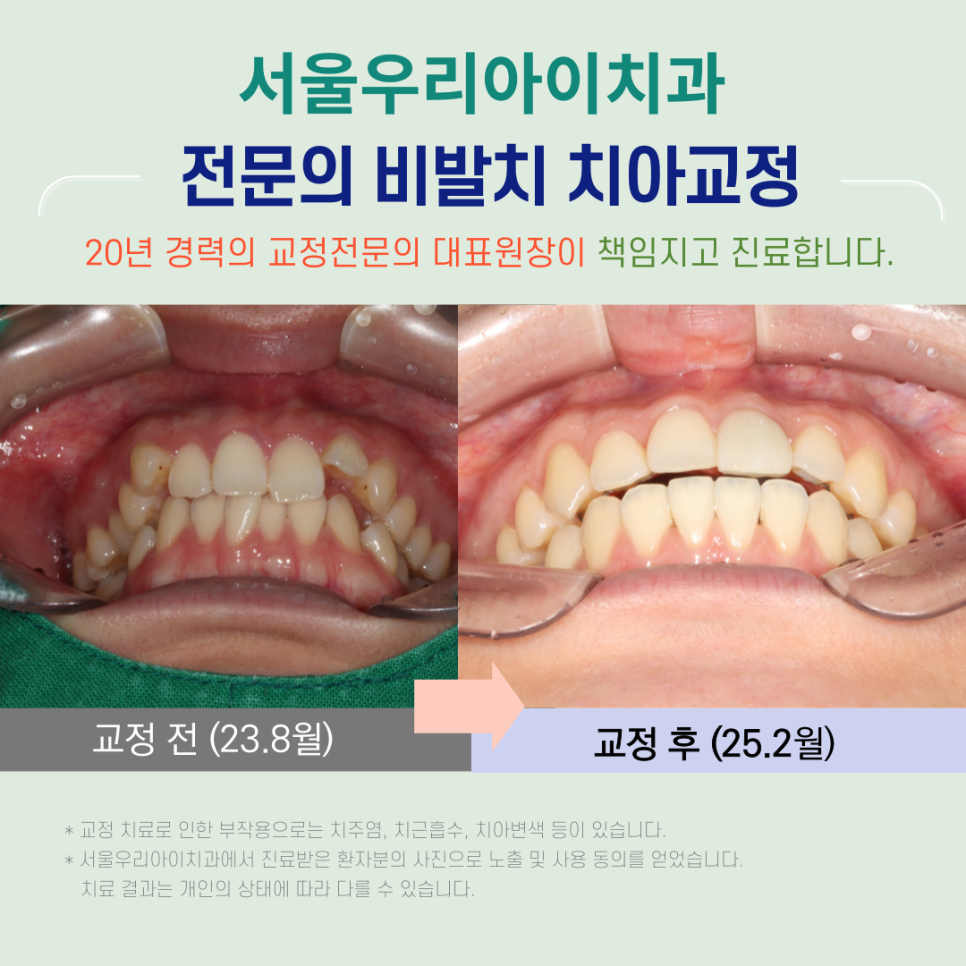 광산구교정치과에서 덧니를 해결하는 방법은?