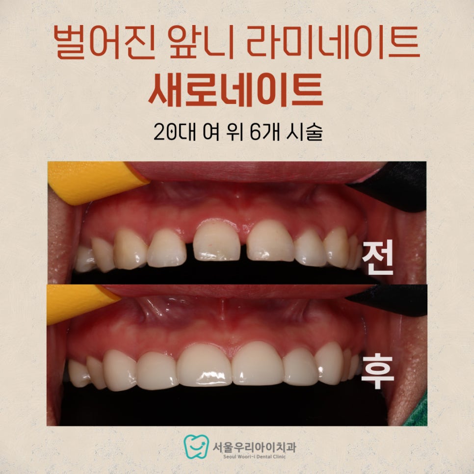 작고 벌어진 앞니를 치료하는 방법이 있을까요? 광주 라미네이트...