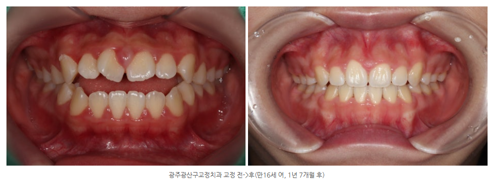 광주광산구교정치과에서 삐뚤어진 앞니를 교정하는 방법은?