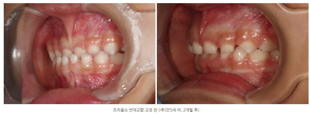 프리올소 반대교합을 해소한 세 가지 사례 (만9세, 만7세, 만5세)