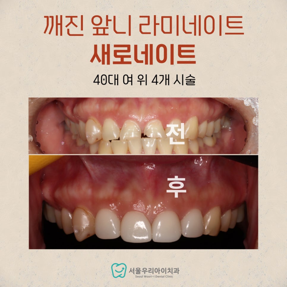 광주에서 깨진 앞니 치료를 잘하는 치과가 궁금하다면?