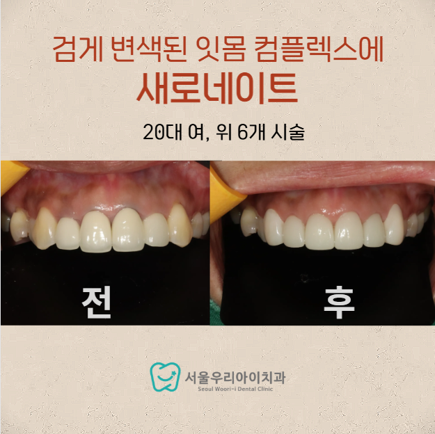 광주라미네이트 치과에서 검게 변한 잇몸색을 개선하는 새로네이트 ...