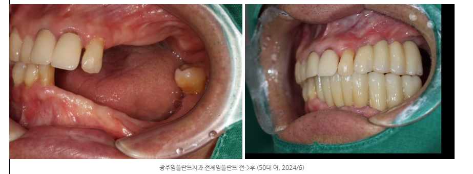 수완지구 임플란트 후에 씹는 맛이 좋아졌다는 실제 사연은?