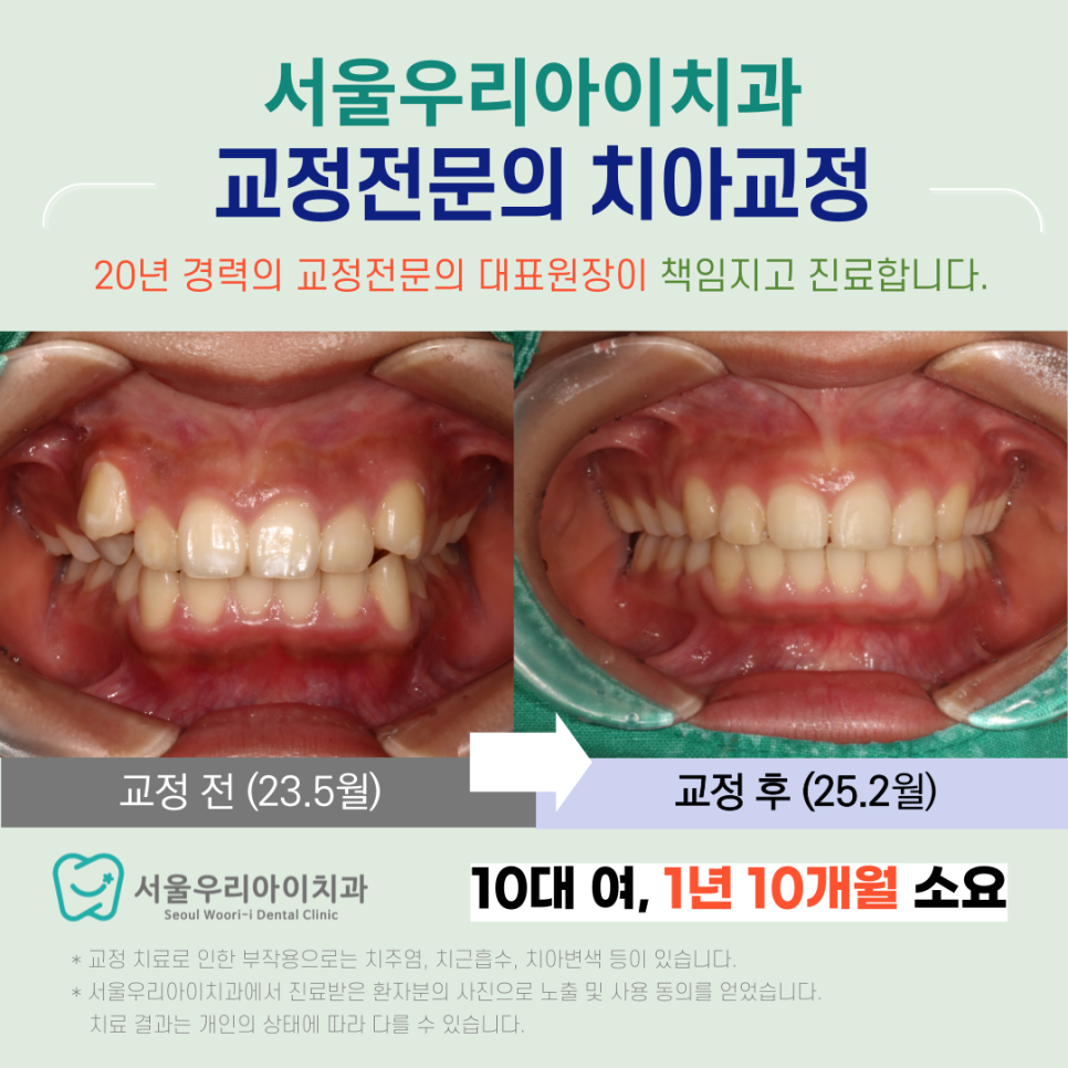 클리피씨 교정의 장점은 무엇일까요? 클리피씨 교정 가격은?