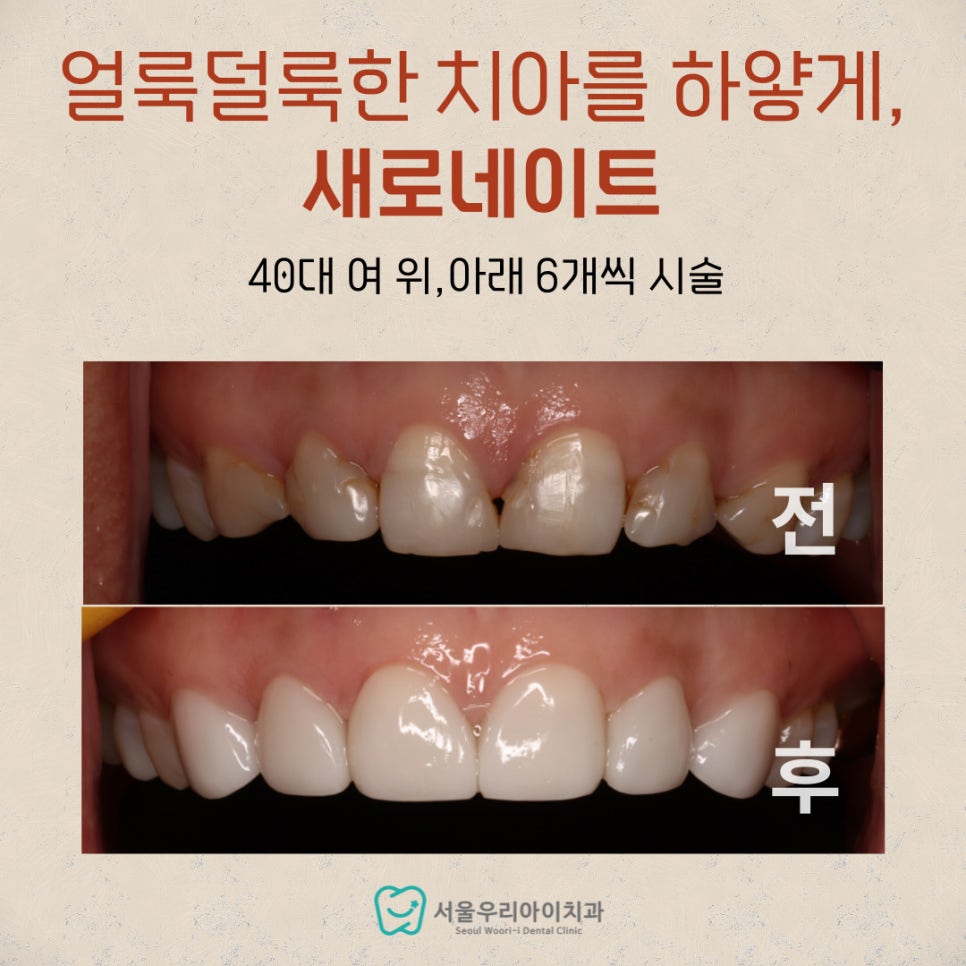 광주 치아미백 후기가 궁금하다면? 반영구 치아미백 효과의 새로네이트