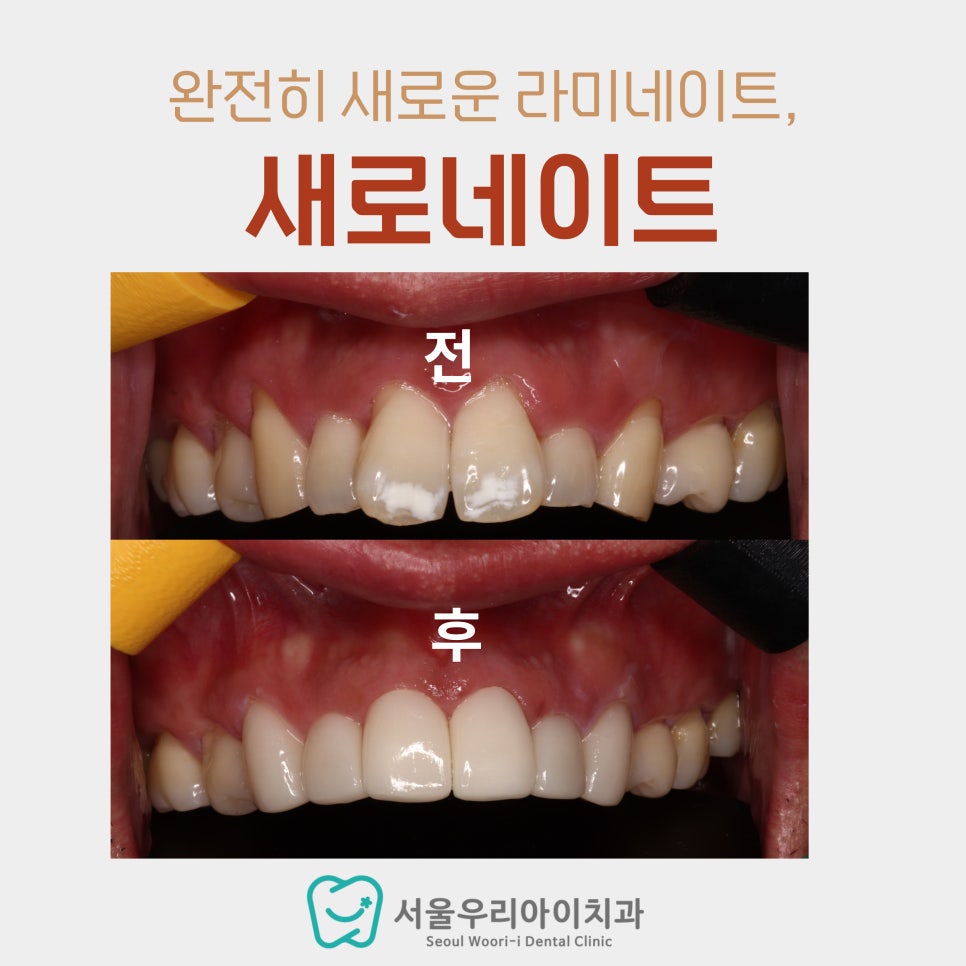 광주에서 부분교정, 급속교정 할 수 있는 치과를 찾는다면?