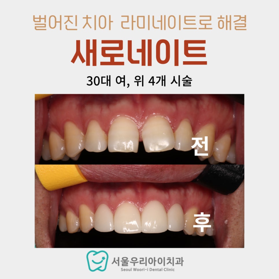 앞니 두 개 사이가 멀어요. 앞니가 벌어져있어요. 앞니 벌어짐...