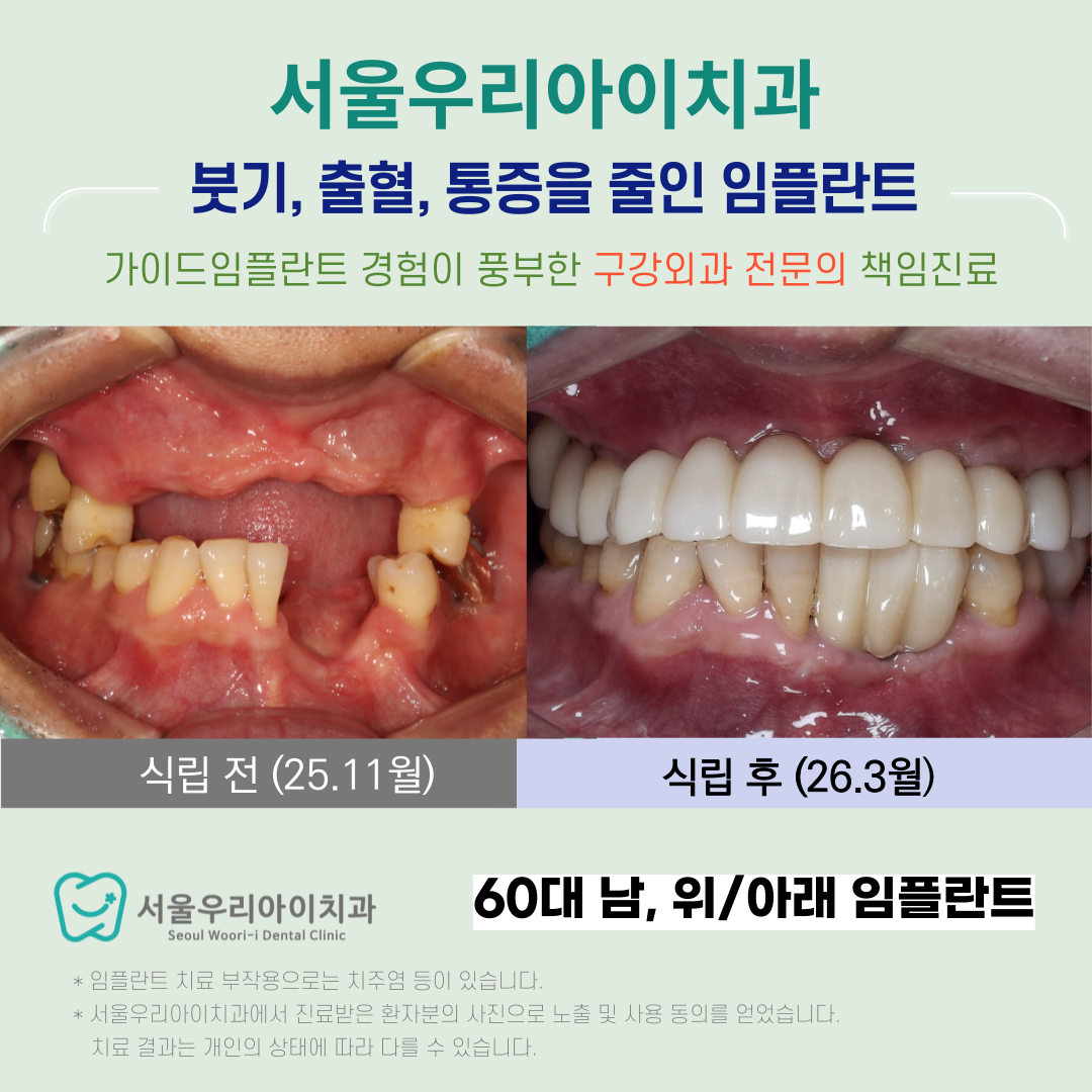 전남광주 임플란트 구강외과 전문의 진료로 정확하게 성공하는 전체...