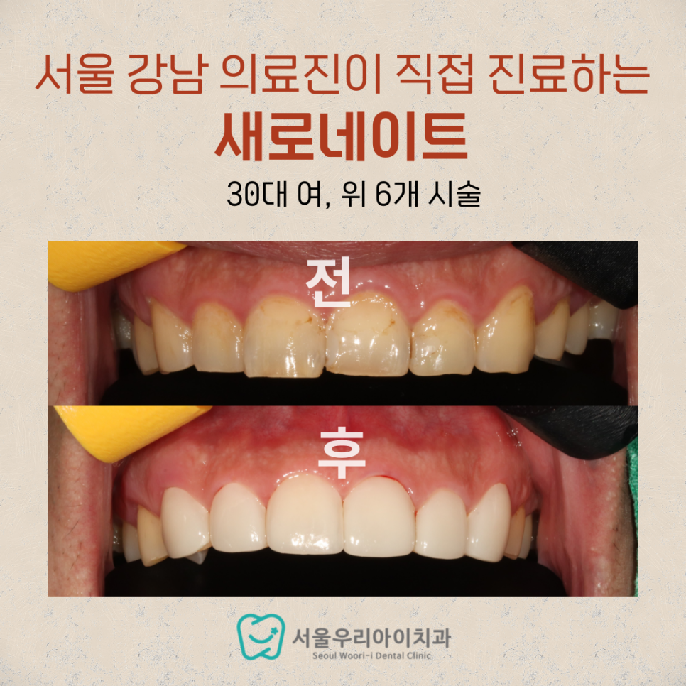 누런치아가 고민이라면? 광주 누런치아 고민하는 사람 모여라
