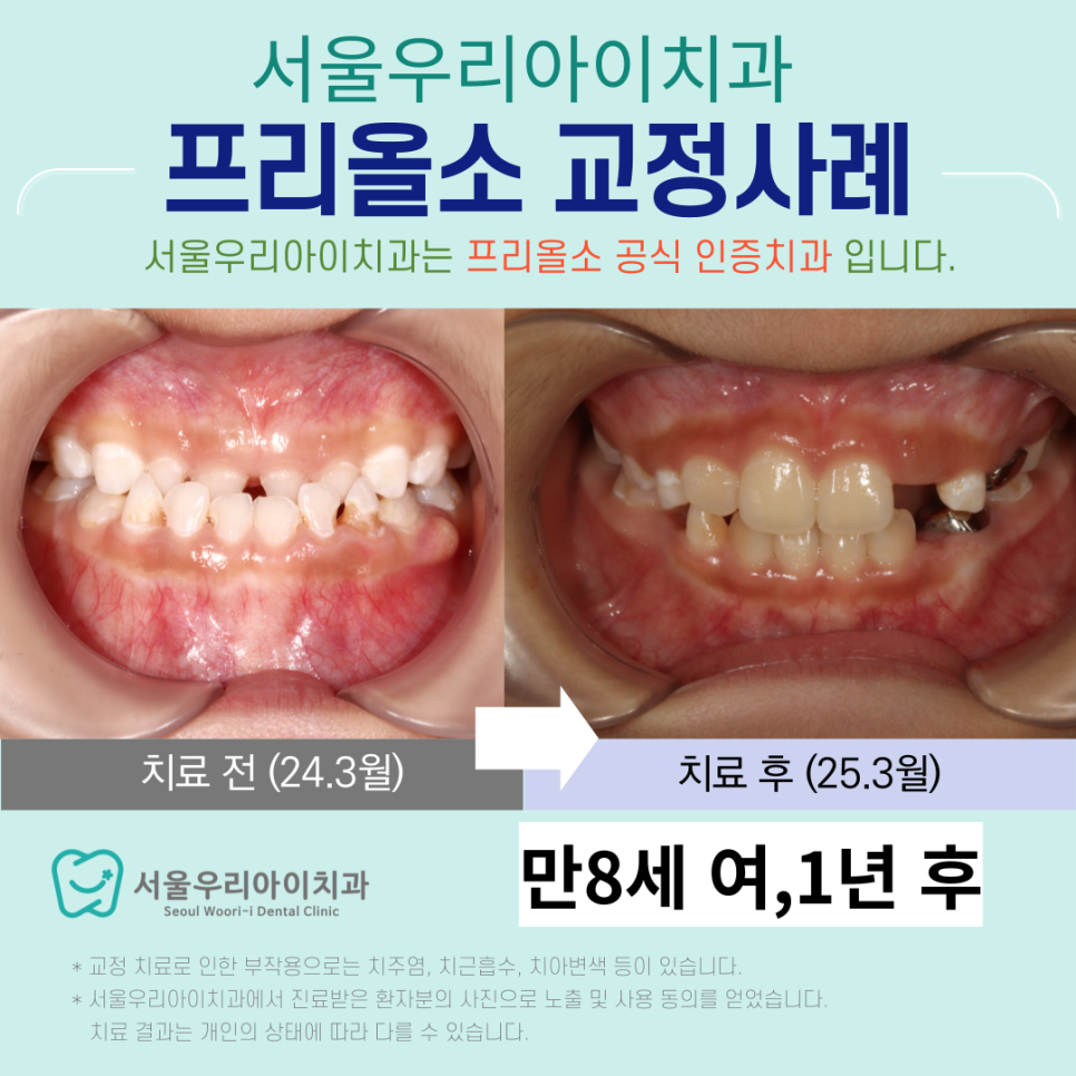 소아 부정교합의 종류와 해결방법이 궁금하다면? 필독!