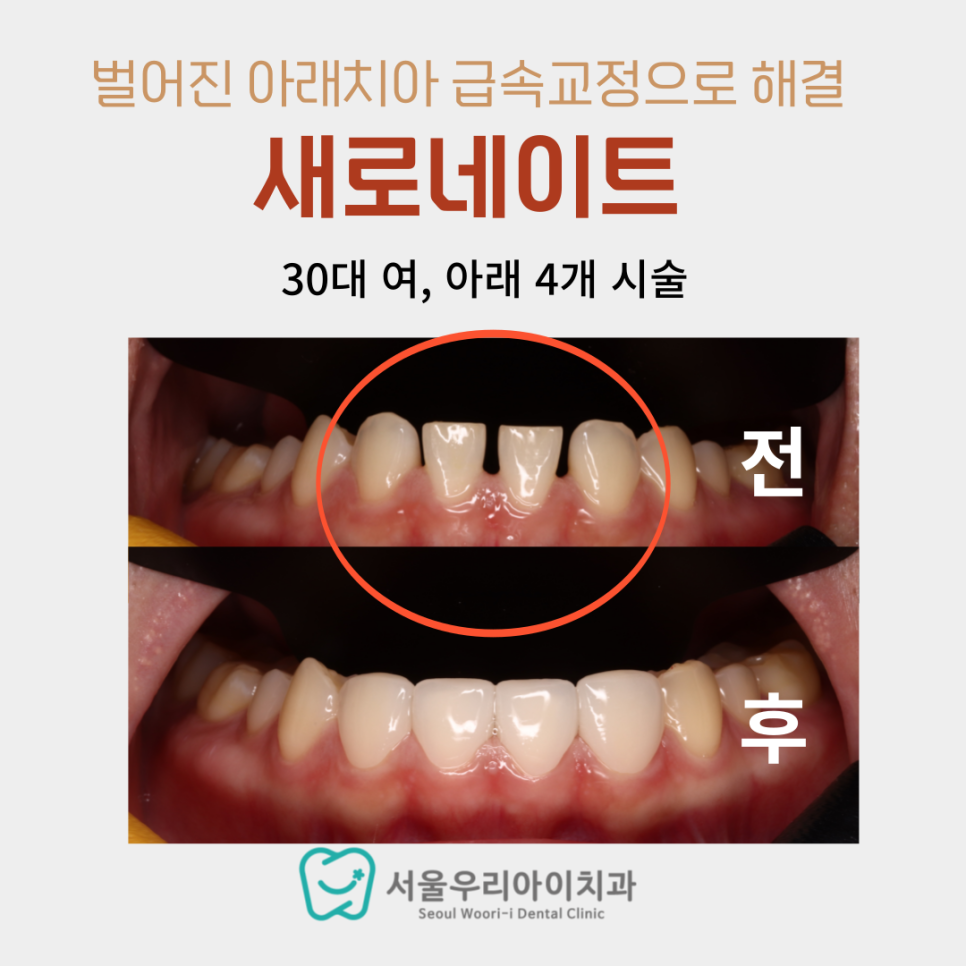 광주mbc 1분건강정보치과에서 아랫니 라미네이트에 대해 궁금한...