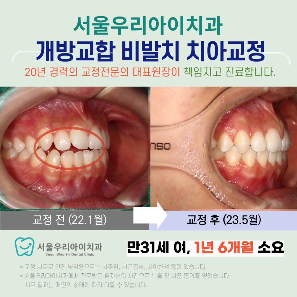 광주광역시교정치과 교정전문의 진료로 오픈바이트 (개방교합) 교정하기