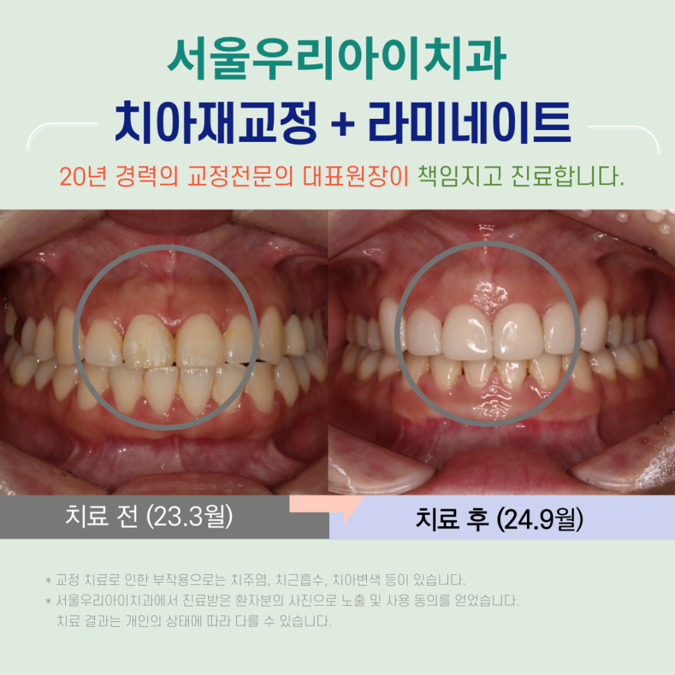 광주광역시 치아재교정 할 수 있는 교정치과는?