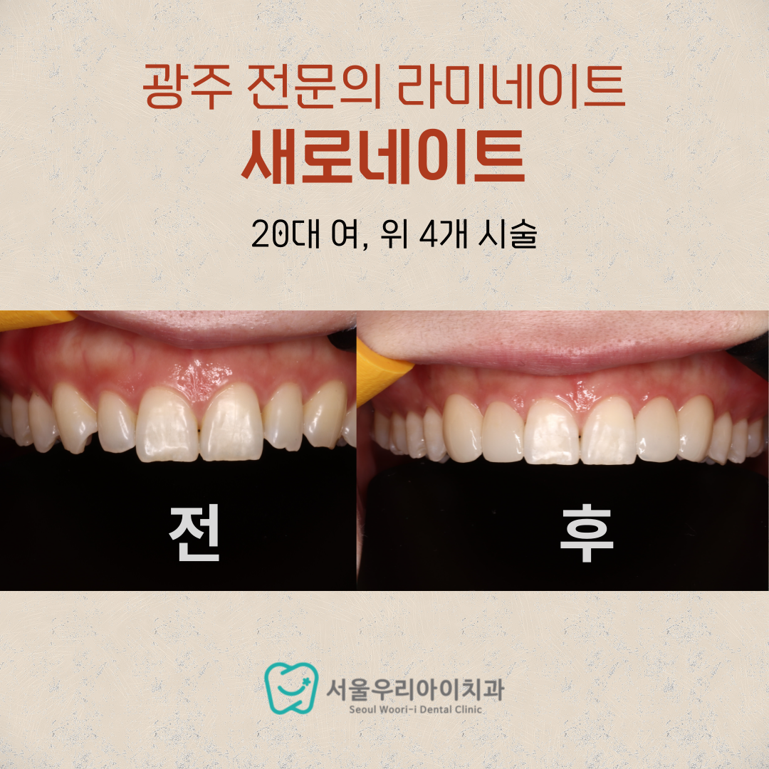 광주 무삭제라미네이트 서울 강남까지 가지 않아도 최고급 퀄리티로