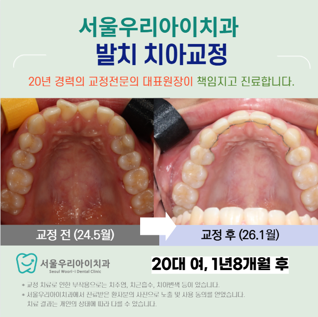 광주 치아교정 치과를 선택할 때 중요한 것이 궁금하다면