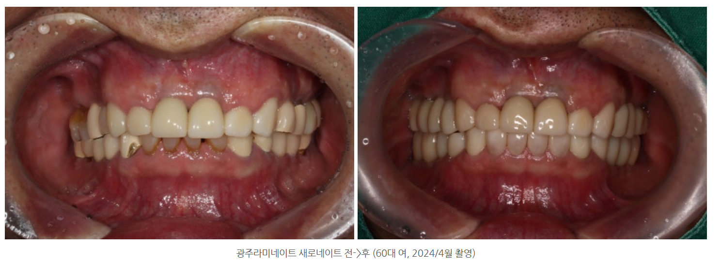 광주에서 전문의가 진료하는 라미네이트 치료로 깊게 물려 잇몸이...