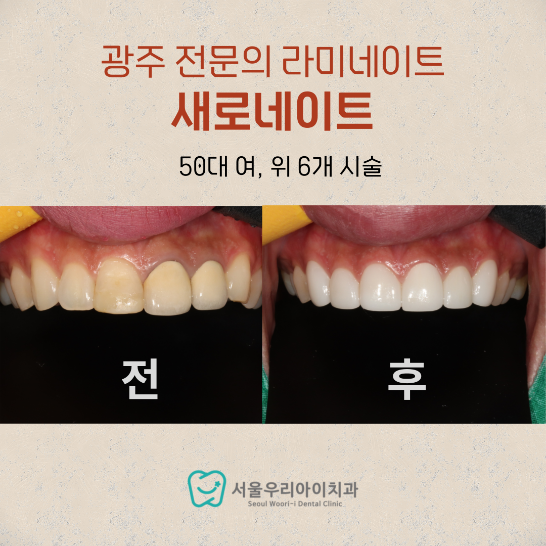 광주 라미네이트 치과 최소한의 삭제로 자연치아를 지키는 기술력으...