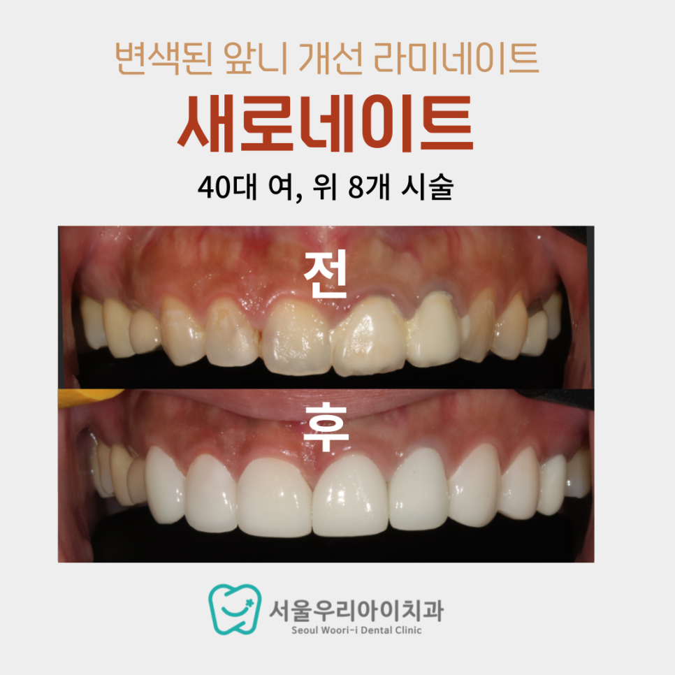 앞니에 갈색으로 반점이 보일 때 해결할 수 있는 방법이 궁금해요