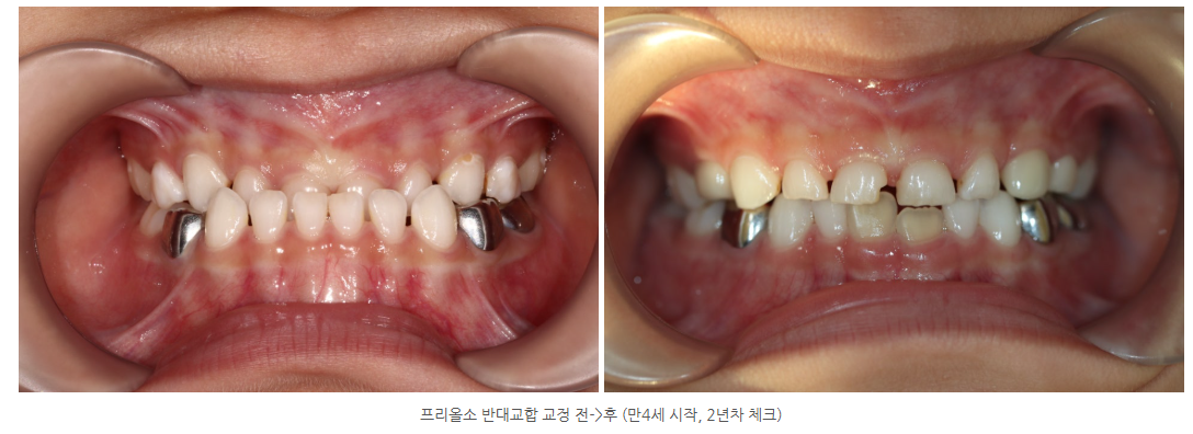 프리올소 광주소아교정치과에서 반대교합교정 만4세부터 시작해서 2...