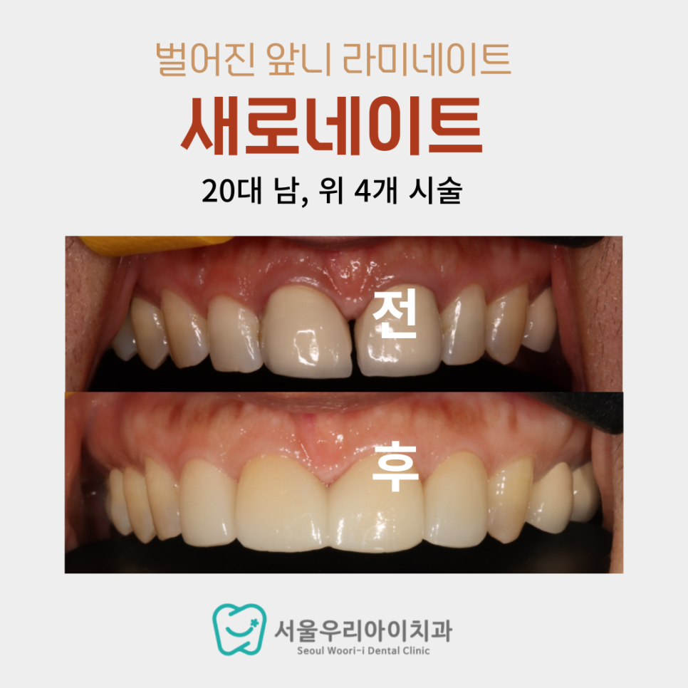 벌어진 앞니 때문에 후회하기 싫다면 이것 확인해보세요!