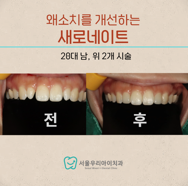 광주라미네이트치과에서 왜소치를 개선한 사례가 궁금하디면