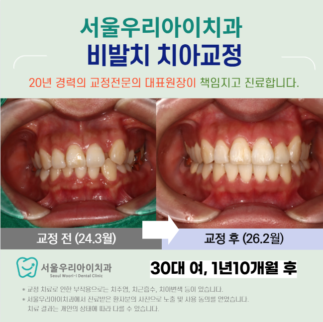 광주 치아교정비 월 진료비용까지 모든 비용을 포함한 금액으로 교...