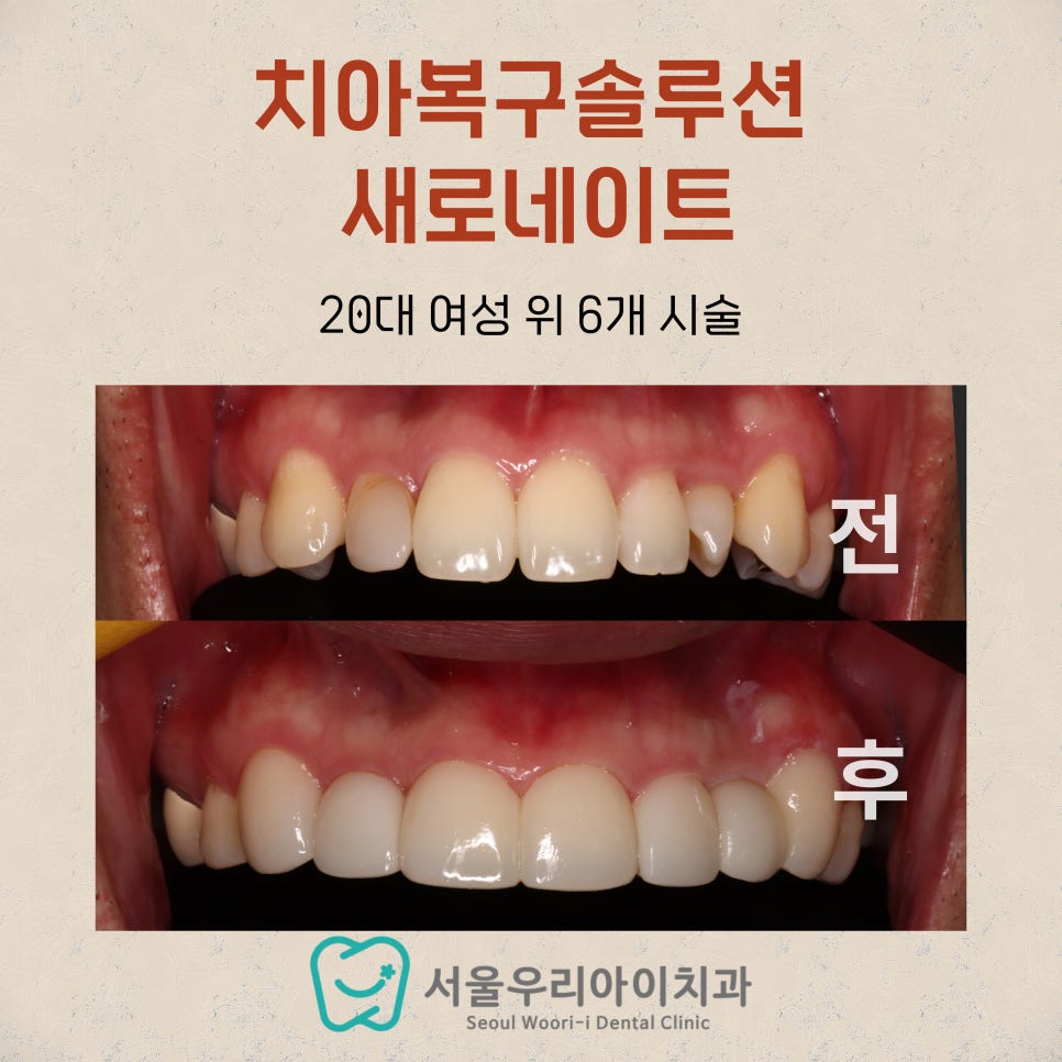 광주광역시 무삭제(최소삭제) 라미네이트로 완전히 새로운 새로네이트!