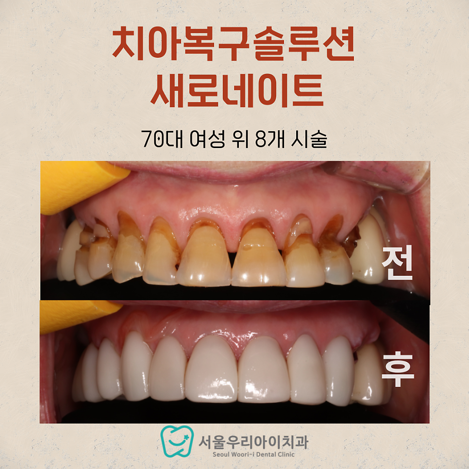 라미네이트가 가능한 나이가 있나요? 라미네이트 70대도 가능합니다!