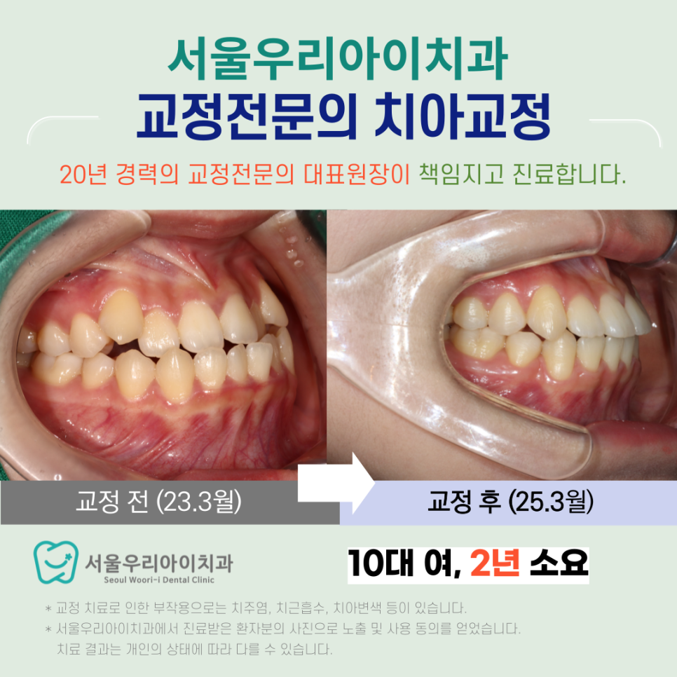광주발치교정치과에서 주걱턱인 부정교합을 개선하는 사례