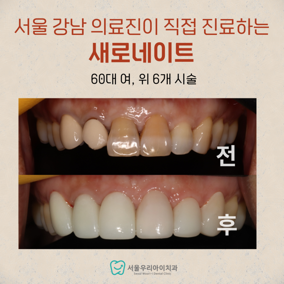 앞니 라미네이트 60대가 해도 될까요?