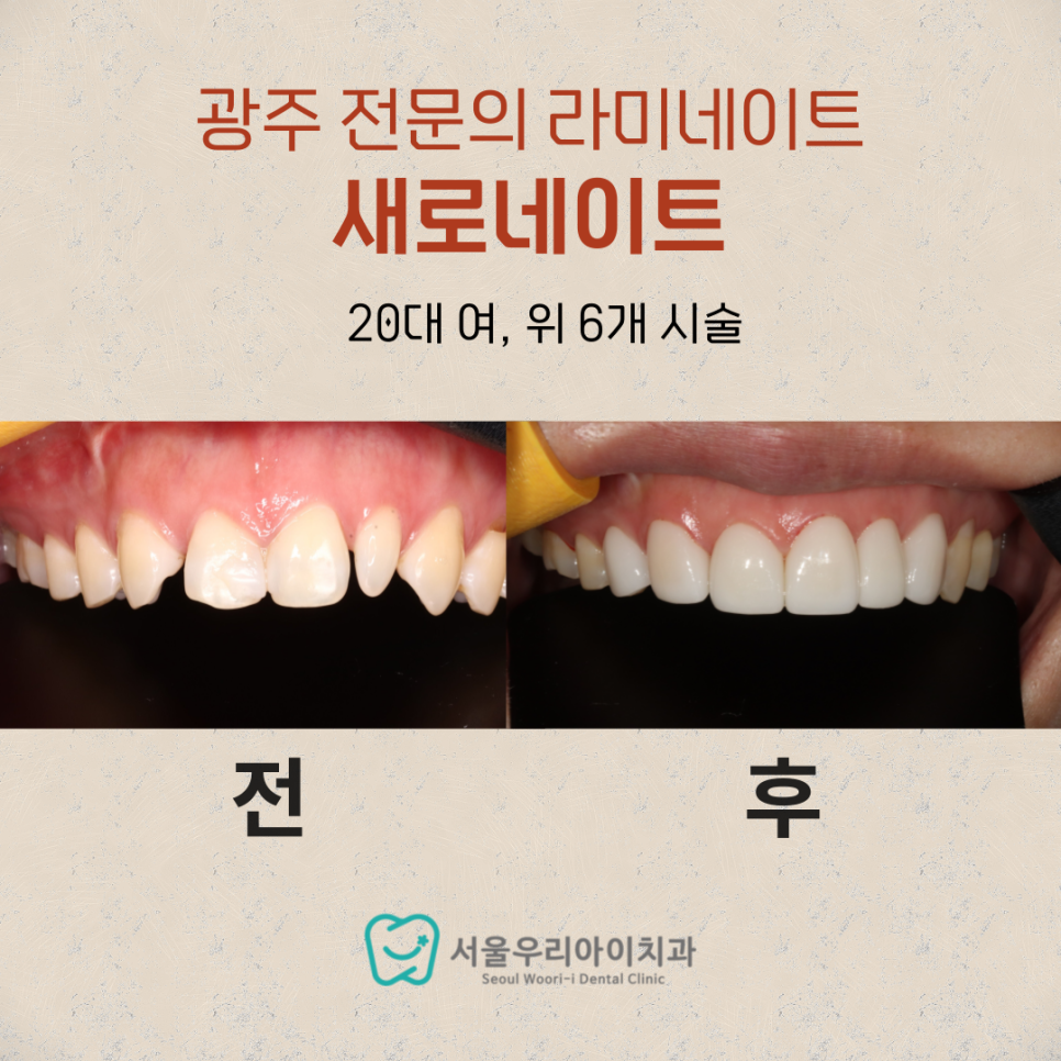 광주 라미네이트 급속교정 앞니 라미네이트로 치아크기를 맞추고 고...