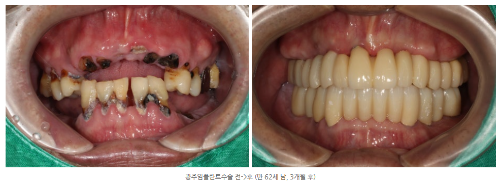 광주광역시에서 전체 임플란트를 잘하는 치과를 찾고 있다면?