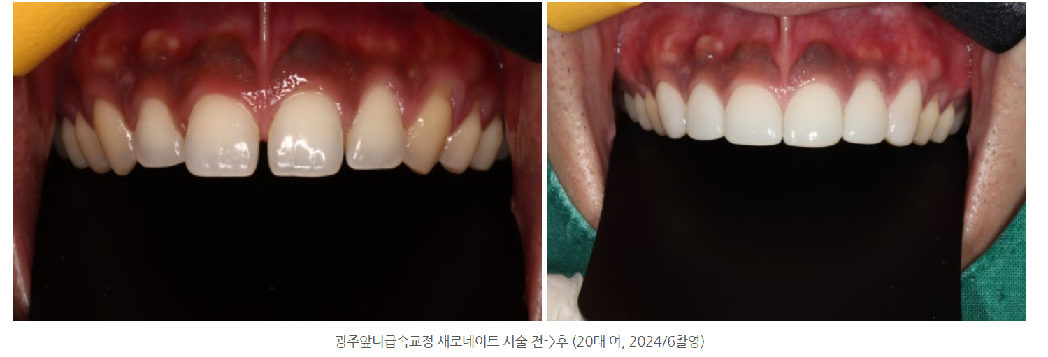 앞니가 벌어져서 불편해요. 앞니 틈으로 자꾸 음식물이 껴서 불편...