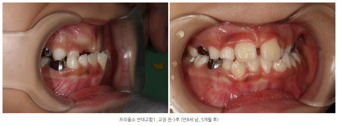 1차 근기능교정장치인 프리올소는 어떤 작용을 할까요?
