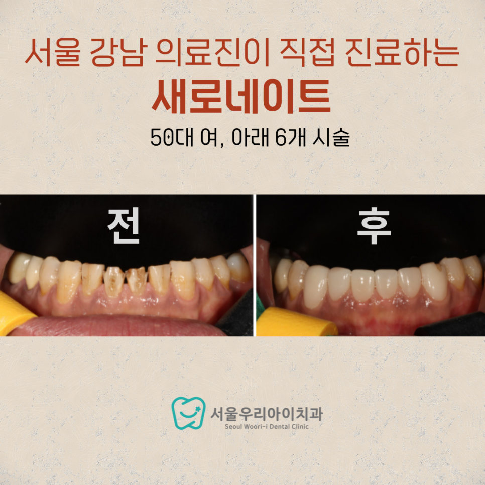 광주 50대 여성이라면 궁금해하는 라미네이트 진료