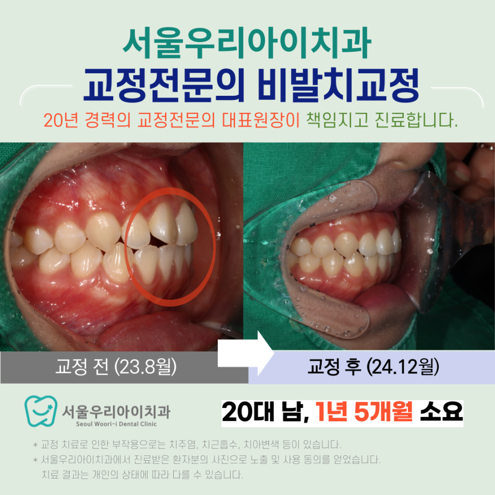치아를 뽑지 않고 치아교정이 가능할까요 ? 비발치치아교정 케이스는?