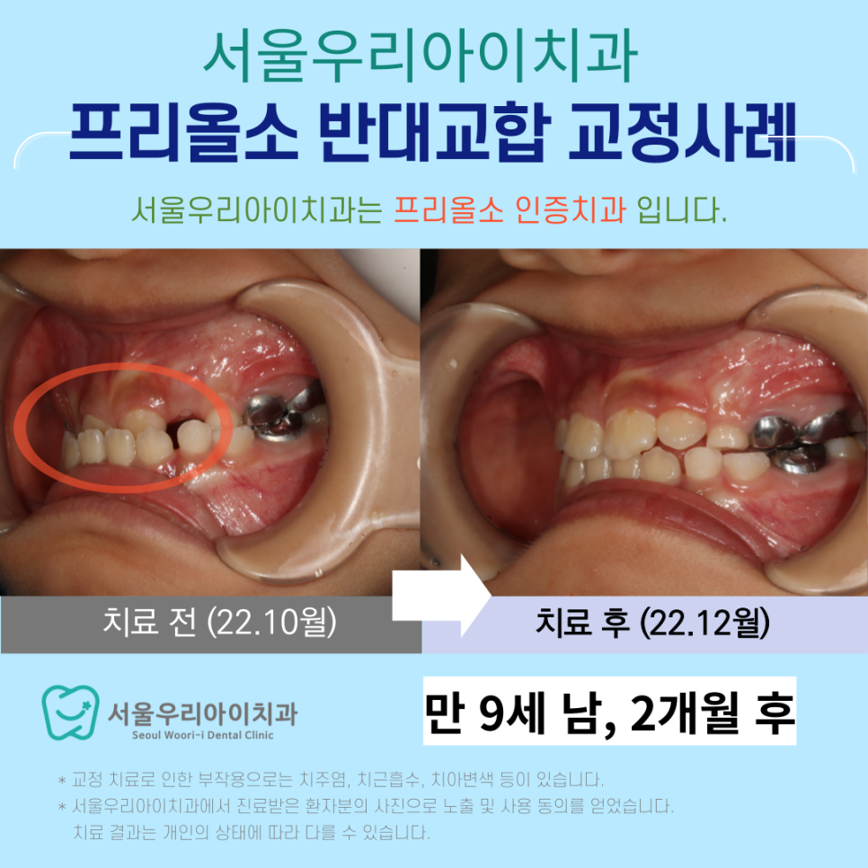 프리올소 광주교정치과 주걱턱과 반대교합 해소는 경험많은 곳에서