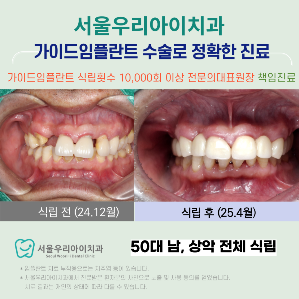 광주 디지털 임플란트 잘하는 광산구 임플란트 치과는?