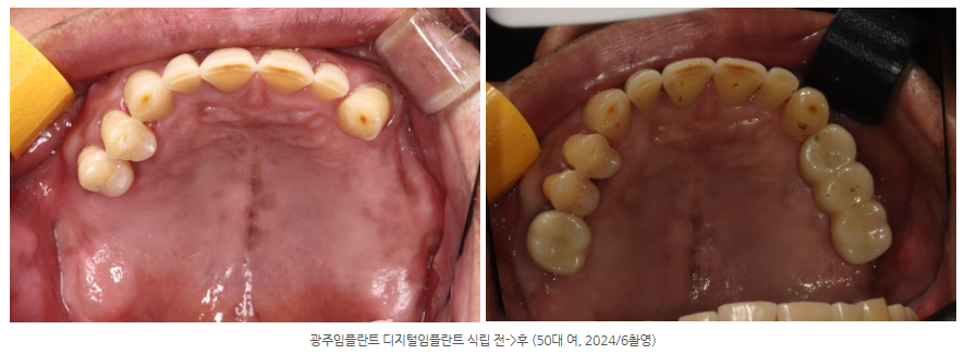 수완지구 임플란트 위, 아래를 완성하기 위해 몇 번이나 수술할까요?