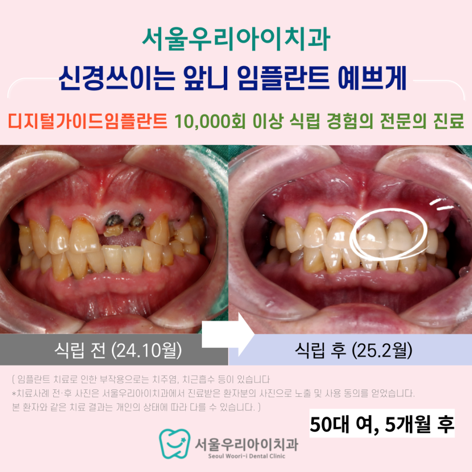 광주 앞니 임플란트 치과에서 앞니를 예쁘게 완성하는 방법은?