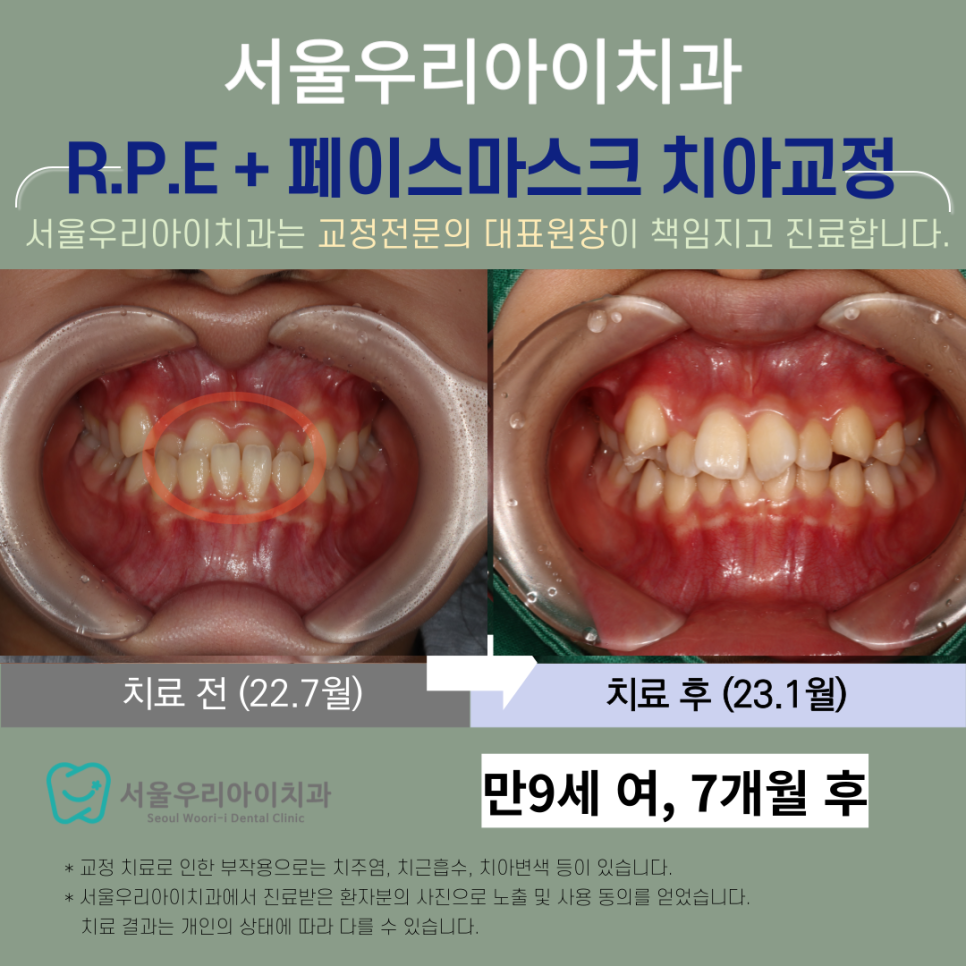 광주어린이교정치과 페이스마스크 교정도 하나요?