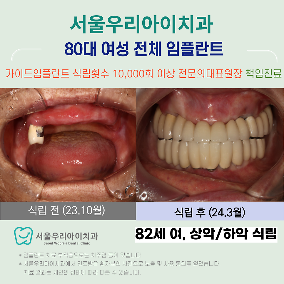 광주 80대 여성의 전체 임플란트 완성이 궁금하다면?