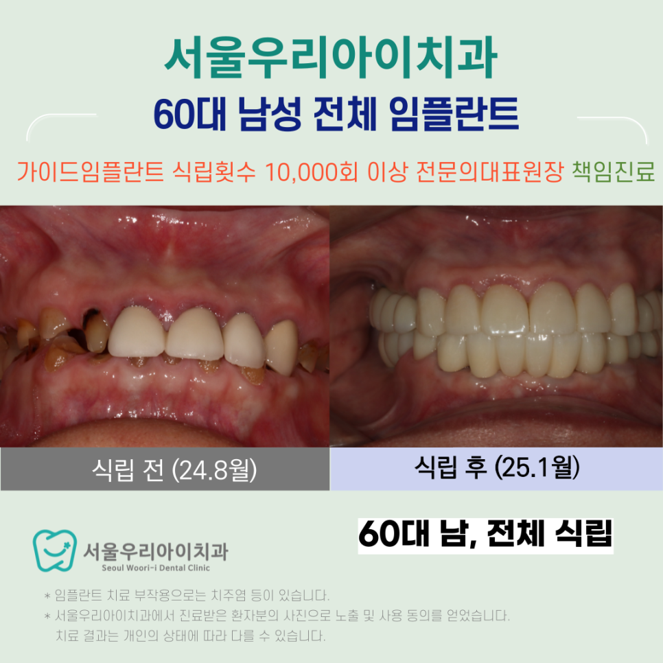 수완지구 임플란트 수완동 임플란트 잘하는 치과를 찾는다면?