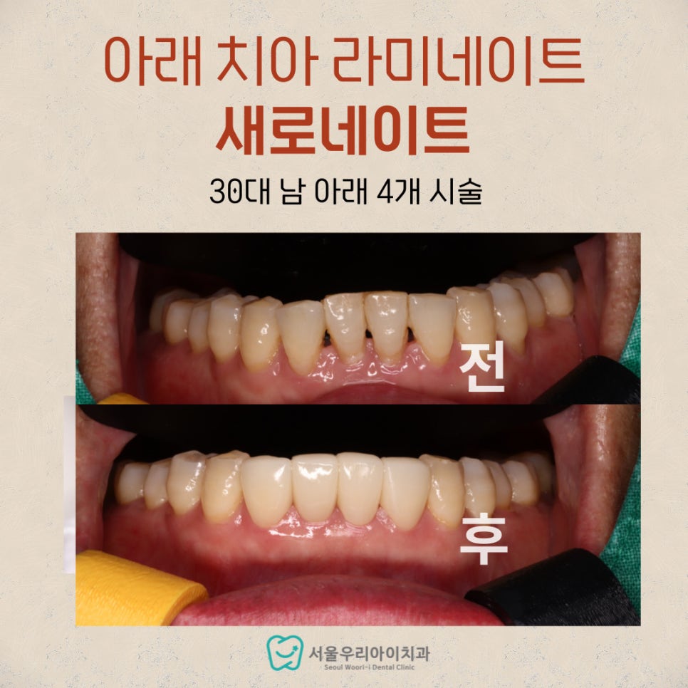 전체 치아교정이 부담스러울 때 해결법이 궁금하다면 필독하세요!