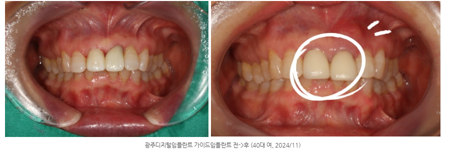 광주 신경치료하고 나서도 이가 흔들린다면?