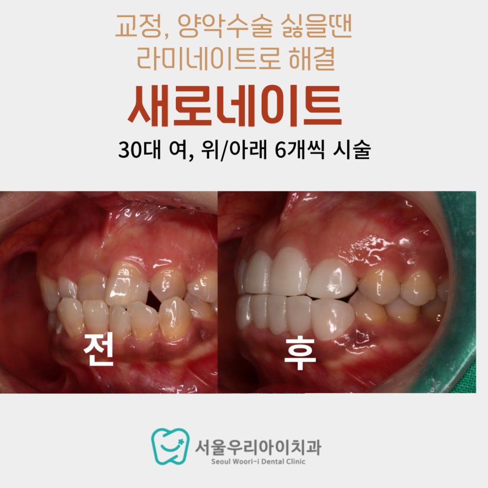 전체 치아교정이나 양악수술은 절대 싫은 20대, 30대 후회하지...