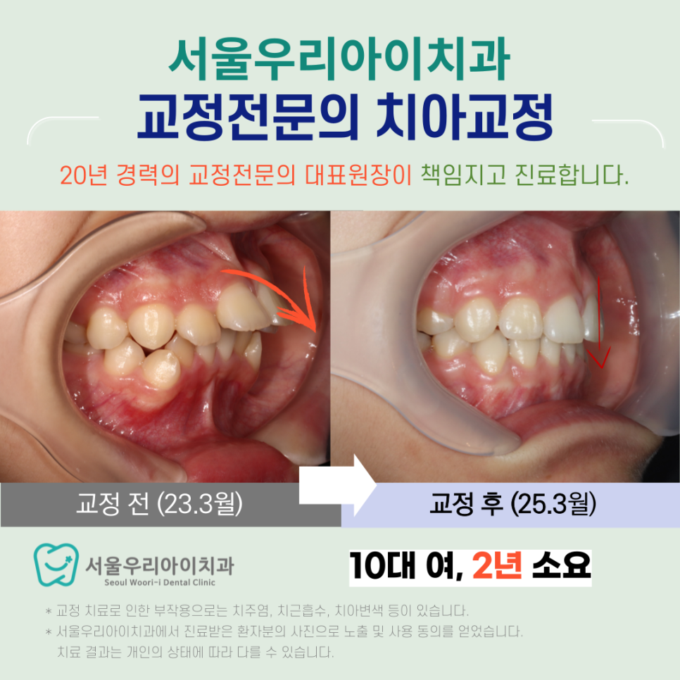광주광역시에서 10대 청소년 교정치과에서 치아교정 사례가 있나요?