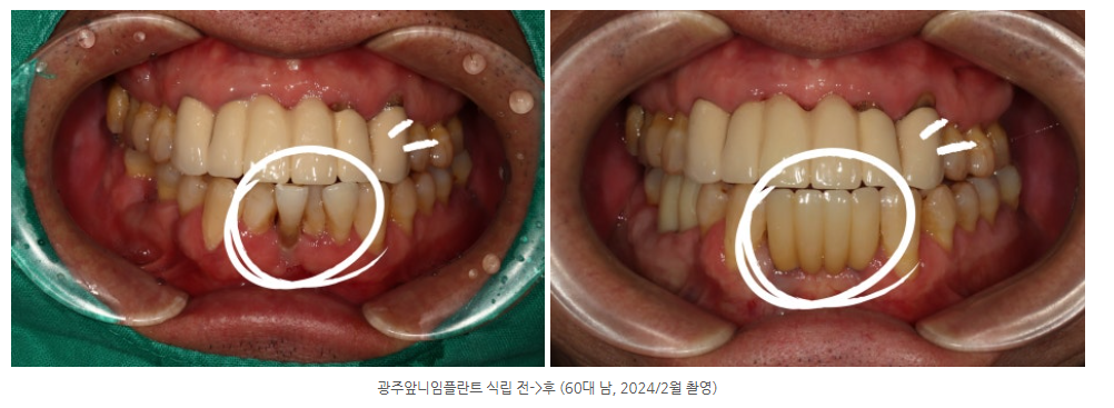 수완지구 임플란트 치과에서 앞니 아랫니 임플란트를 완성하는 비결은?