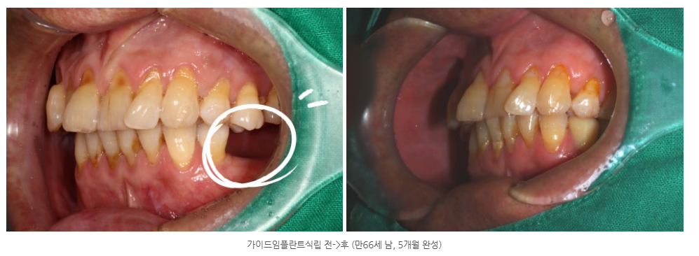 광산구 임플란트 치과에서 왼쪽 어금니와 오른쪽 어금니 임플란트를...