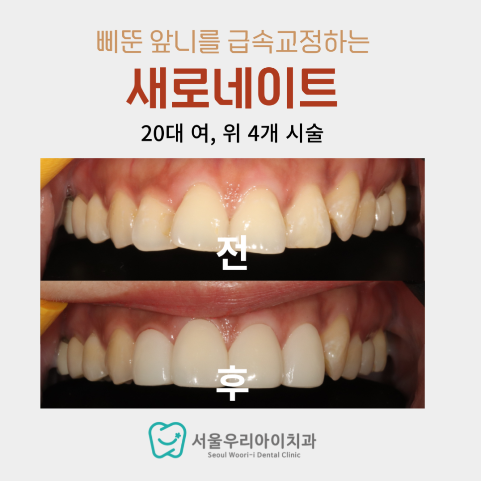 20대 앞니가 삐뚤어져서 고민이라면 광주에서 해결할 수 있어요
